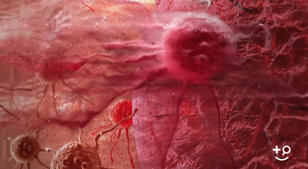 Lung Cancer Types Doctorpedia Doctor Reviewed Video lung-cancer-types-doctorpedia-doctor-reviewed-video