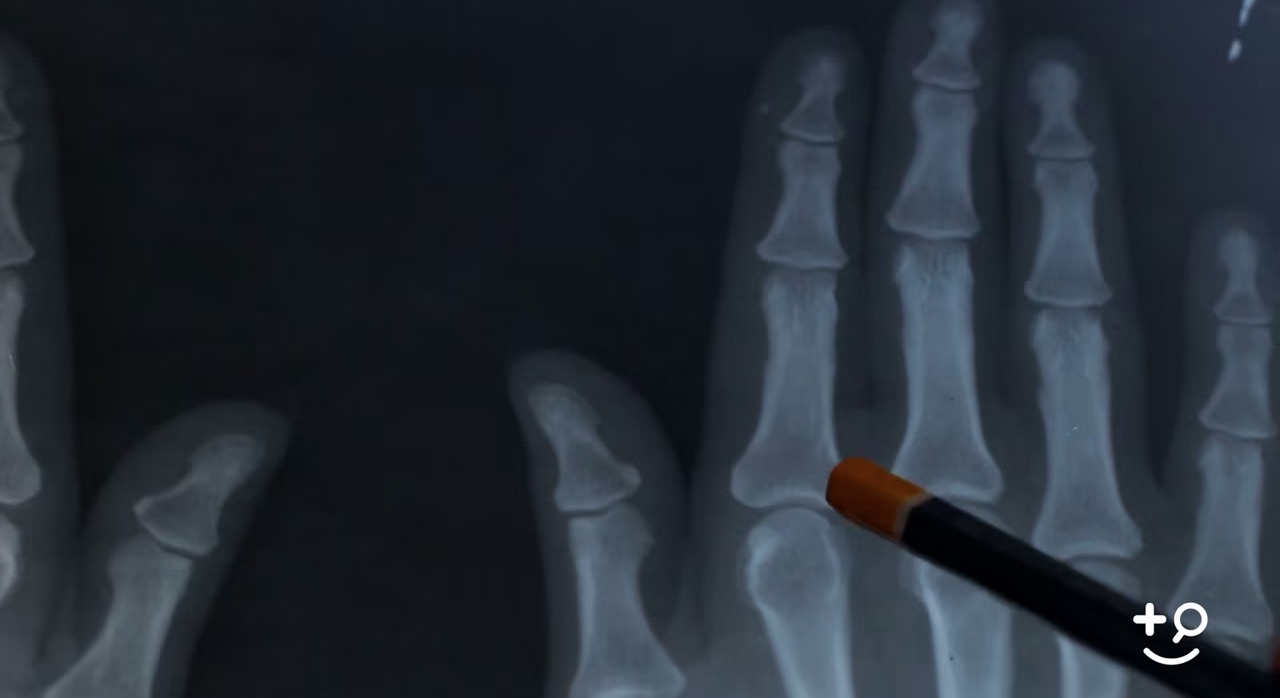 Arthritis Hereditary Doctorpedia DoctorReviewed Video